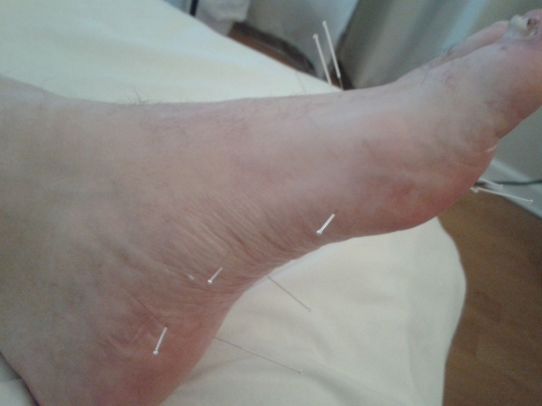 Acupuncture Omaha