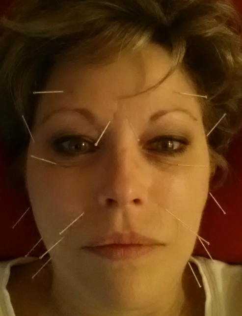 Omaha Acupuncture