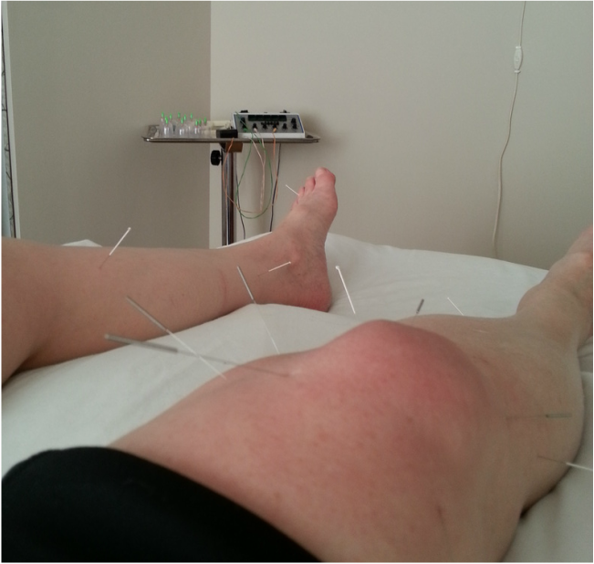 Omaha Acupuncture