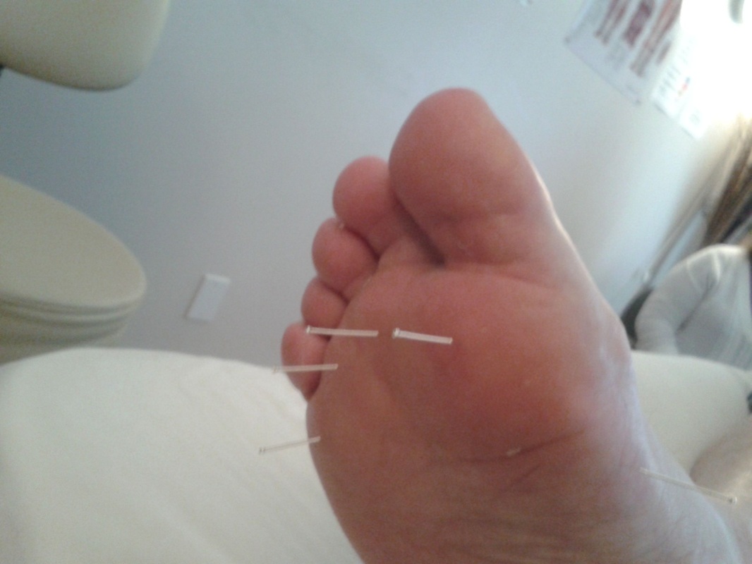 Acupuncture Omaha